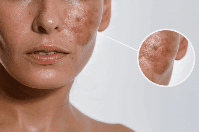 Brown Spots Suddenly Appeared On Skin