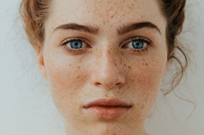 Hyperpigmentation Treatment