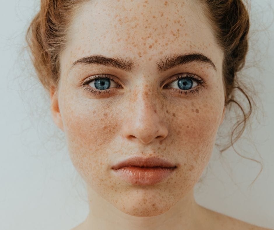 hyperpigmentation treatment
