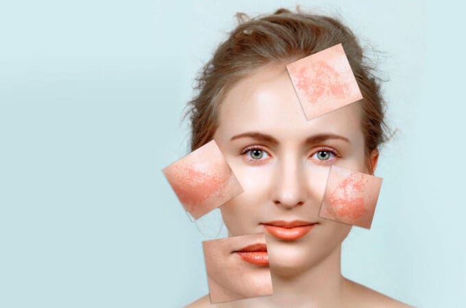 What Is Melasma And Chloasma