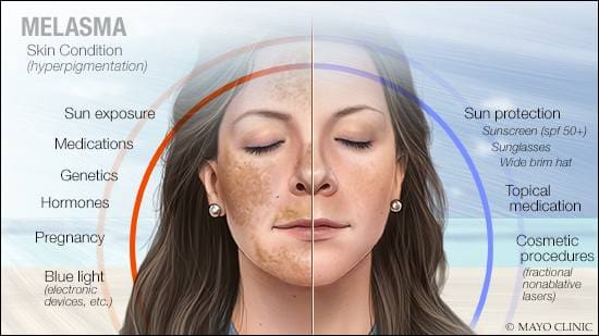 heat triggers melasma