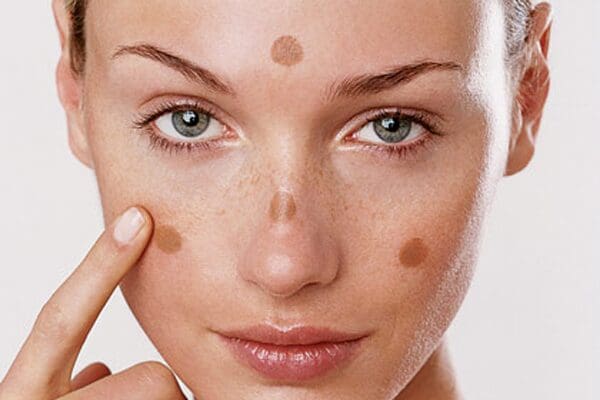 What Causes Melasma