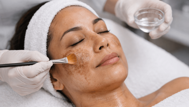 Gentle Chemical Peels For Melasma Management